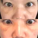 下まぶたたるみ取り セオリークリニック DAY 3 サムネイル用
