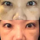 下まぶたたるみ取り セオリークリニック DAY 5 サムネイル用