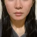 ヒアルロン酸注入（頬） / ヒアルロン酸注入（鼻翼基部） KIMI CLINIC 形成・美容外科 DAY 11 サムネイル用