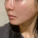 ヒアルロン酸注入（頬） / ヒアルロン酸注入（鼻翼基部） KIMI CLINIC 形成・美容外科 DAY 11 サムネイル用