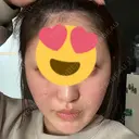 その他（口元） A CLINIC（エークリニック） 大阪院 DAY 23 サムネイル用