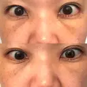 下まぶたたるみ取り セオリークリニック DAY 7 サムネイル用