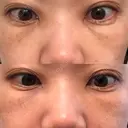 下まぶたたるみ取り セオリークリニック DAY 8 サムネイル用