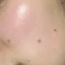 ほくろ・いぼ切除（肌） フローラクリニック DAY 8 サムネイル用