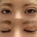 二重埋没 形成外科と美容外科のクリニック池袋 DAY 5 サムネイル用