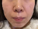 ほくろ・いぼ除去レーザー（肌） Fellez Clinic【フェルズクリニック】 AFTER サムネイル用