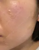 ほくろ・いぼ除去レーザー（肌） Fellez Clinic【フェルズクリニック】 DAY 0 サムネイル用