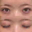 二重埋没 コスメディカルクリニック シンシア 銀座院 DAY 12 サムネイル用