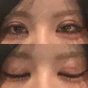 二重埋没 形成外科と美容外科のクリニック池袋 DAY 5 サムネイル用