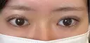 二重埋没 EMMA CLINIC（エマクリニック） DAY 7 サムネイル用