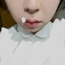 ハイフ（顔） 表参道メディカルクリニック 名古屋院 DAY 13 サムネイル用