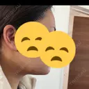 脂肪吸引（顔） 4Dクリニック DAY 2 サムネイル用