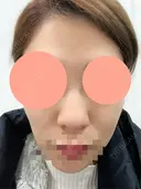 ヒアルロン酸注入（鼻） 博多美容外科/美容皮膚科 ビラビューティークリニック AFTER サムネイル用