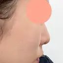 ヒアルロン酸注入（鼻） 博多美容外科/美容皮膚科 ビラビューティークリニック DAY 8 サムネイル用