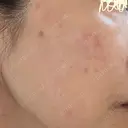 プラセンタ注射 / シミ取りレーザー S-Laboクリニック 渋谷院 DAY 9 サムネイル用