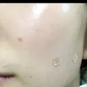 ほくろ・いぼ切除（肌） フローラクリニック DAY 9 サムネイル用