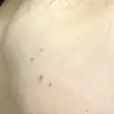 ほくろ・いぼ切除（肌） フローラクリニック DAY 9 サムネイル用