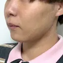 糸リフト / バッカルファット除去 / 脂肪吸引（顔） / メーラーファット除去 / ジョールファット除去 / その他（輪郭） First Clinic DAY 14 サムネイル用