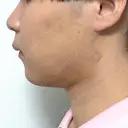 糸リフト / バッカルファット除去 / 脂肪吸引（顔） / メーラーファット除去 / ジョールファット除去 / その他（輪郭） First Clinic DAY 14 サムネイル用