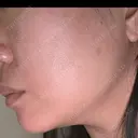 ハイフ（顔） A CLINIC（エークリニック） 新宿院 AFTER サムネイル用