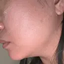 ハイフ（顔） A CLINIC（エークリニック） 新宿院 DAY 2 サムネイル用