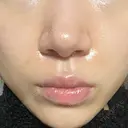 ボトックス（口角） / ヒアルロン酸注入（鼻翼基部） ルラ美容クリニック 大阪本院 DAY 2 サムネイル用