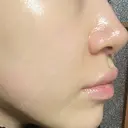 ボトックス（口角） / ヒアルロン酸注入（鼻翼基部） ルラ美容クリニック 大阪本院 DAY 2 サムネイル用