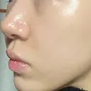 ボトックス（口角） / ヒアルロン酸注入（鼻翼基部） ルラ美容クリニック 大阪本院 DAY 2 サムネイル用