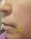 ほくろ・いぼ切除（肌） CLINIC W DAY 21 サムネイル用