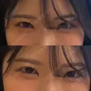 ヒアルロン酸注入（涙袋） PRO CLINIC プロクリニック 銀座院 DAY 4 サムネイル用