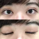 二重切開 / 目頭切開 / ほくろ・いぼ切除（肌） / 上まぶたたるみ取り / 上まぶたの脂肪取り 東京美容外科 銀座院 DAY 54 サムネイル用