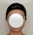糸リフト / ボトックス（エラ・小顔） アリエル美容クリニック 水戸院 AFTER サムネイル用