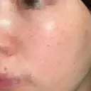 ピーリング（ニキビ・毛穴） / 光治療（フォトフェイシャルなど） ルラ美容クリニック 横浜院 DAY 1 サムネイル用