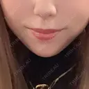 ボトックス（エラ・小顔） / インモード Moon Beauty Clinic AFTER サムネイル用