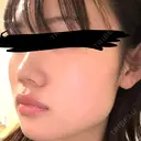 ボトックス（エラ・小顔） DMTC CLINIC 日本橋院 DAY 0 サムネイル用