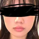 ボトックス（エラ・小顔） DMTC CLINIC 日本橋院 DAY 0 サムネイル用