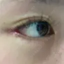 目尻切開 / タレ目形成・グラマラスライン（切開） R Beauty CLINIC 大阪院 DAY 7 サムネイル用