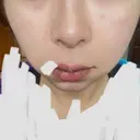 ハイフ（顔） 表参道メディカルクリニック 名古屋院 DAY 25 サムネイル用