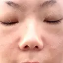 肌ヒアルロン酸注入（たるみ・シワ改善） 博多美容外科/美容皮膚科 ビラビューティークリニック DAY 0 サムネイル用