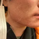 医療脱毛（顔） ZX-CLINIC 梅田院 AFTER サムネイル用