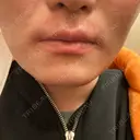 医療脱毛（顔） ZX-CLINIC 梅田院 DAY 0 サムネイル用