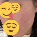 光治療（フォトフェイシャルなど） / ルメッカ 眠れるスキンクリニック田町 DAY 0 サムネイル用