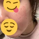 光治療（フォトフェイシャルなど） / ルメッカ 眠れるスキンクリニック田町 AFTER サムネイル用