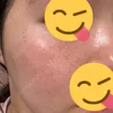 光治療（フォトフェイシャルなど） / ルメッカ 眠れるスキンクリニック田町 DAY 1 サムネイル用