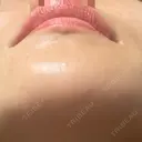 ピコレーザートーニング（美白・肝斑） 博多美容外科/美容皮膚科 ビラビューティークリニック DAY 2 サムネイル用