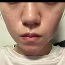 毛穴洗浄（ハイドラフェイシャルなど） / ルメッカ 大美会クリニック 心斎橋本院 DAY 1 サムネイル用