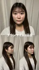 糸リフト / 脂肪吸引（顔） / ジョールファット除去 / ヒアルロン酸注入（あご） / ボトックス（エラ・小顔） 新宿美容外科ネビュラクリニック DAY 2 サムネイル用