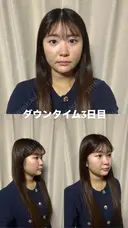 糸リフト / 脂肪吸引（顔） / ジョールファット除去 / ヒアルロン酸注入（あご） / ボトックス（エラ・小顔） 新宿美容外科ネビュラクリニック DAY 3 サムネイル用