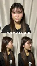 糸リフト / 脂肪吸引（顔） / ジョールファット除去 / ヒアルロン酸注入（あご） / ボトックス（エラ・小顔） 新宿美容外科ネビュラクリニック DAY 7 サムネイル用