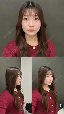 糸リフト / 脂肪吸引（顔） / ジョールファット除去 / ヒアルロン酸注入（あご） / ボトックス（エラ・小顔） 新宿美容外科ネビュラクリニック DAY 12 サムネイル用